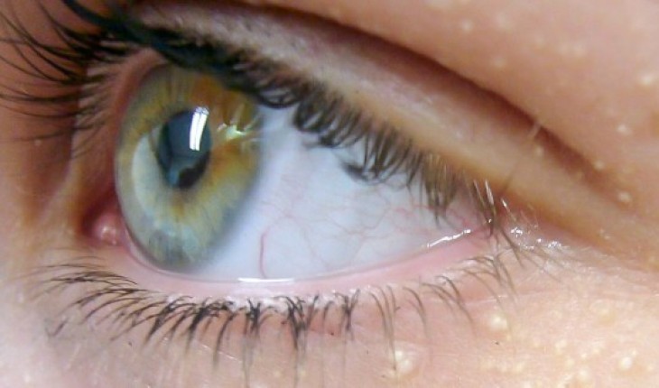 Ты даже не представляешь, о чём свидетельствует появление белых точек вокруг глаз!